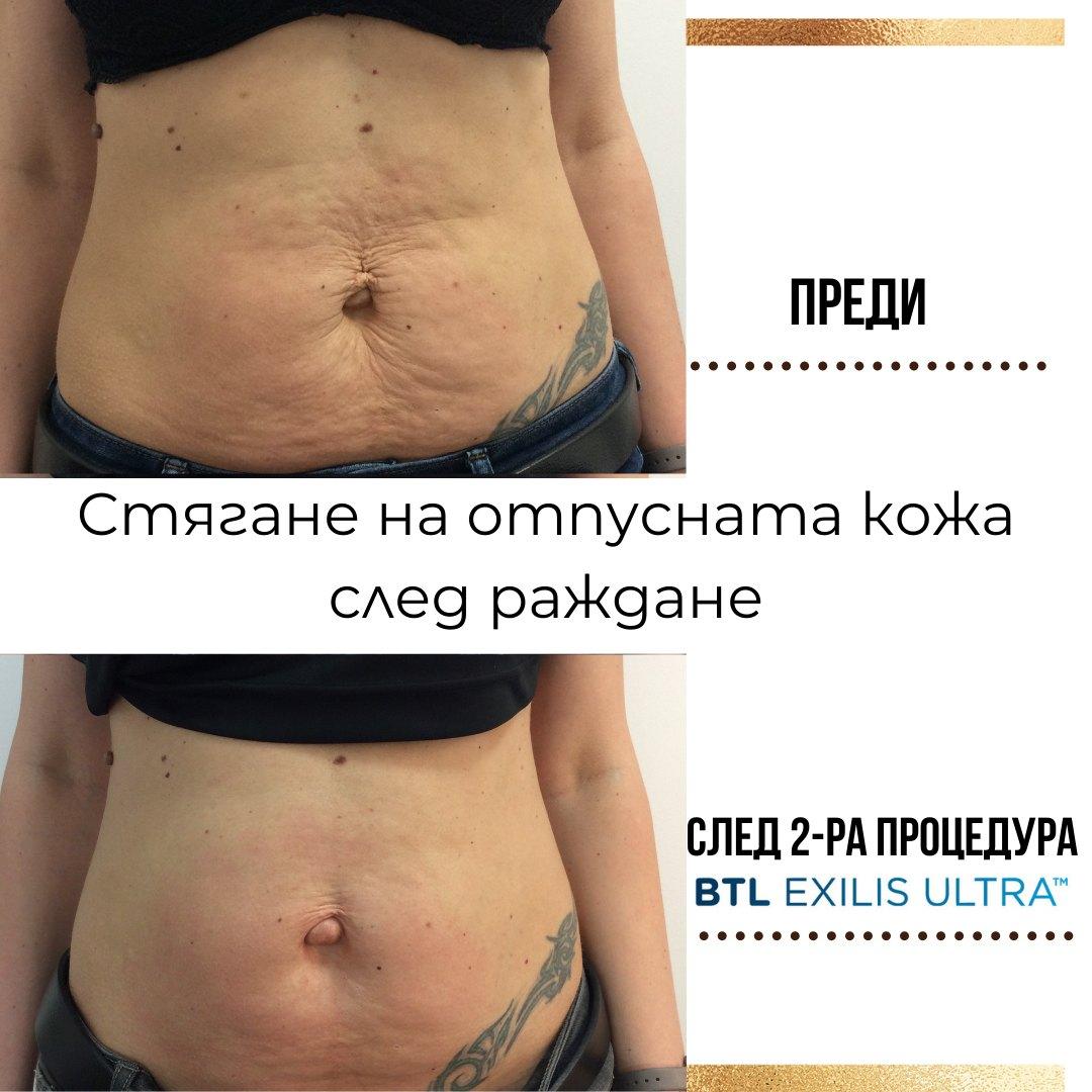 Преди и след BTL Exilis Ultra: стягане на отпусната кожа на корема след раждане, след втора процедура
