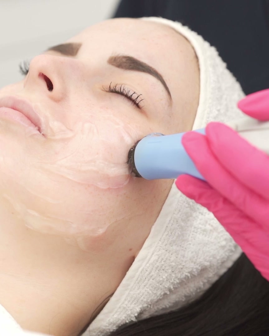 Радиочестотен лифтинг на лицето с BTL Exilis Ultra в Skin Laser