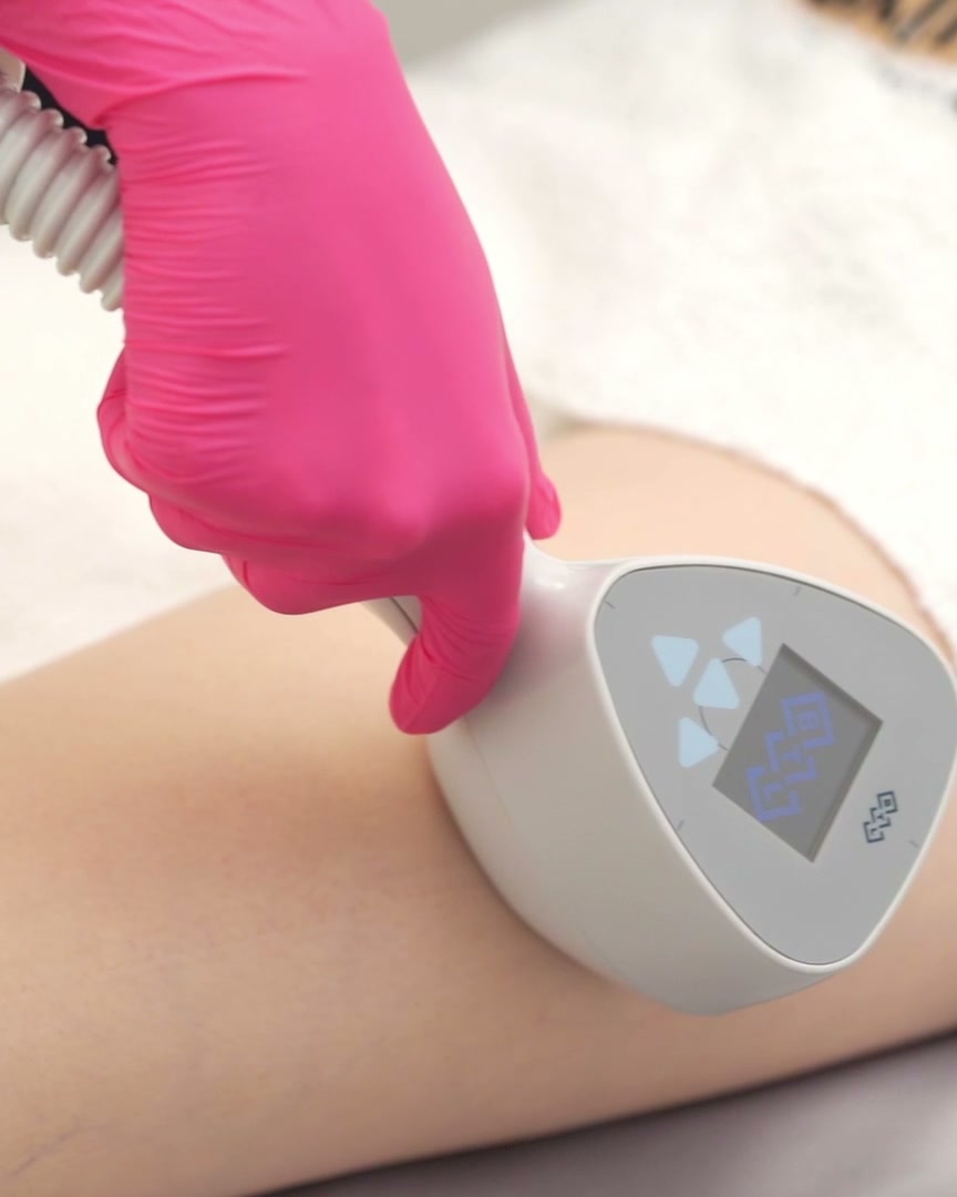 Процедура за тяло с апликатора на BTL Exilis Ultra 360 върху бедро